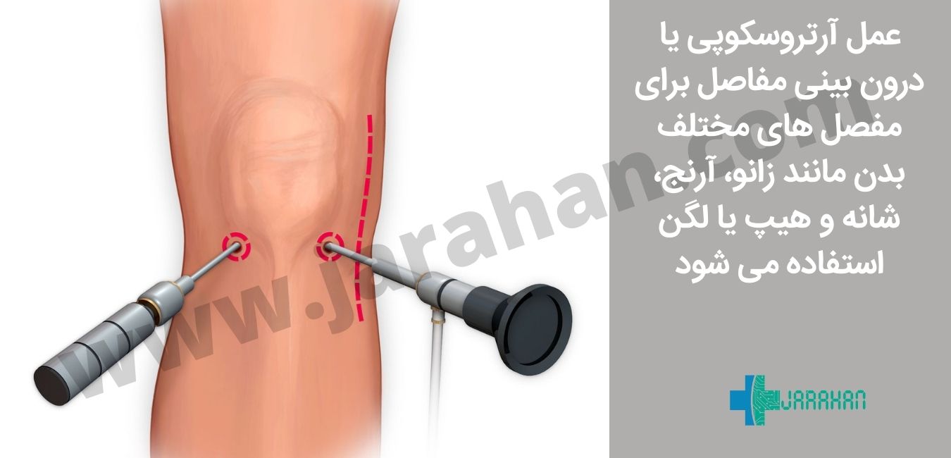 عمل آرتروسکوپی برای مفصل های مختلف بدن انجام می شود